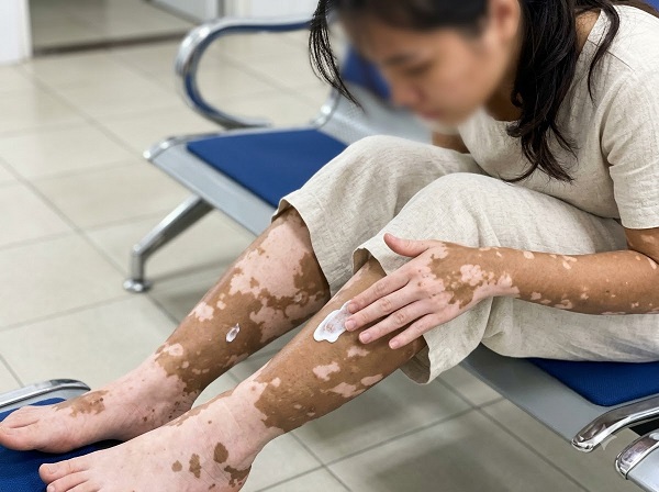 Chia sẻ của người bệnh bạch biến